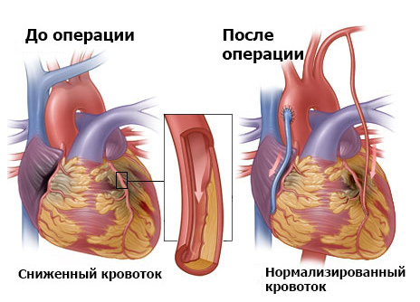 Реваскуляризация миокарда - медицинский центр Инкор, Владикавказ