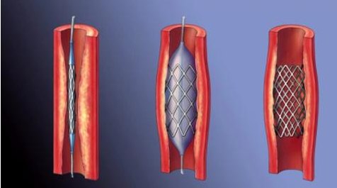 Реваскуляризация миокарда - медицинский центр Инкор, Владикавказ